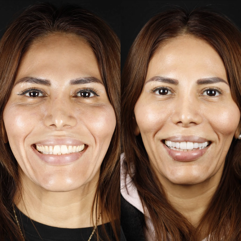 Antes y después — Cinthia Almeda