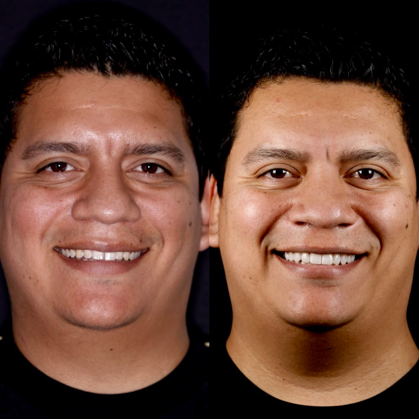 Antes y después — Javier Durón