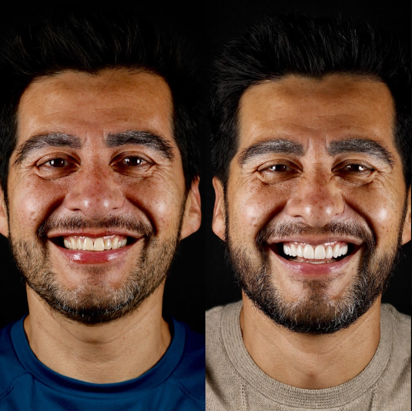 Antes y después — Francisco Hernández