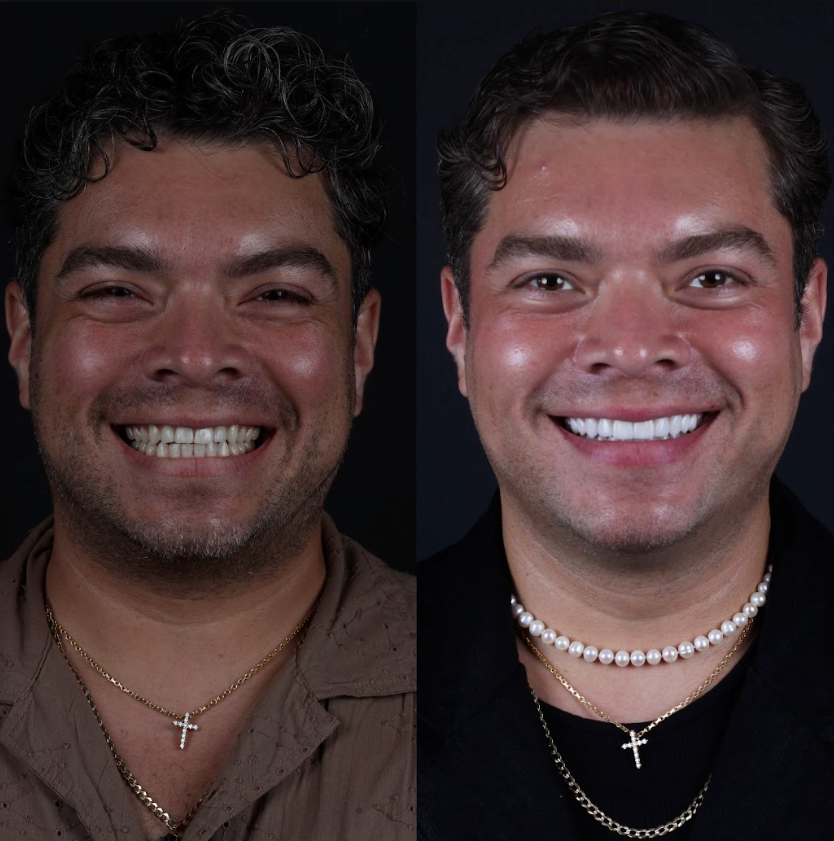 Antes y después — Jekyll Arce