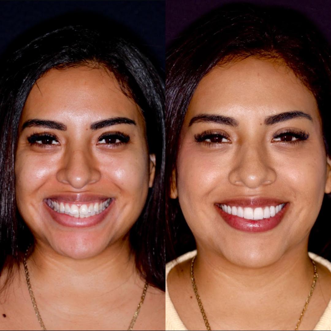 Antes y después — Lesli Gabriela