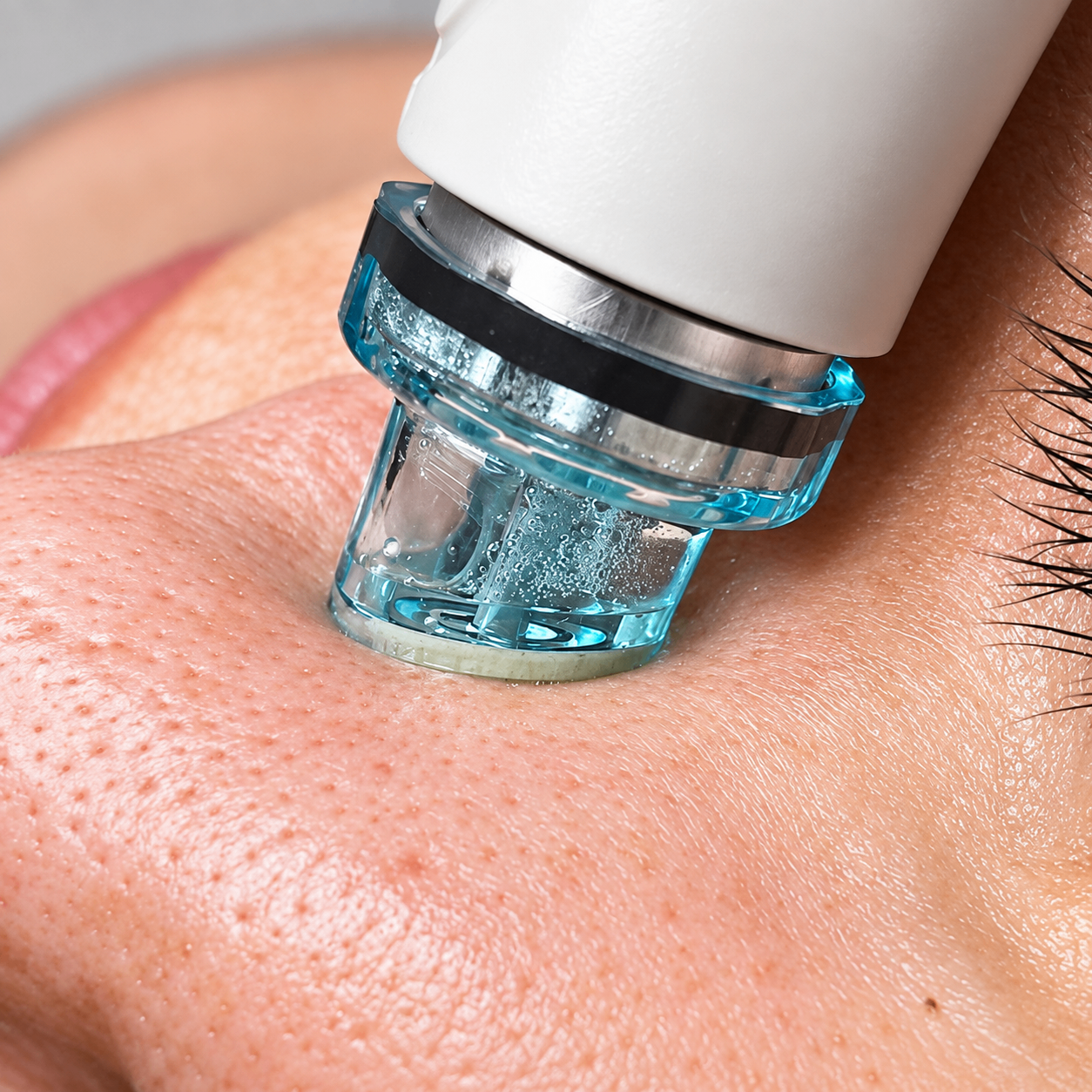 Hydrafacial tip deep-cleansing treatment on the cheek