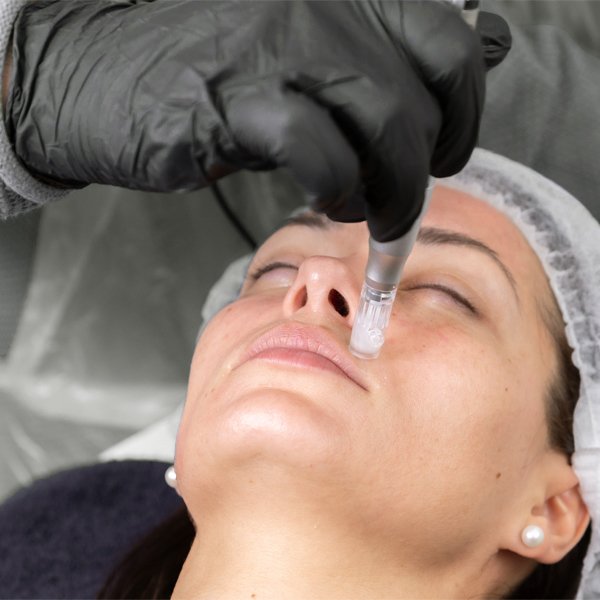 PhiBright Microneedling