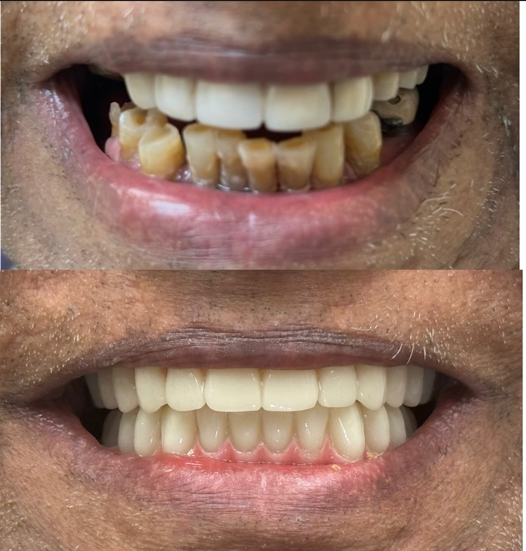 Highline Dental before and after smile transformation 11 in Oviedo FL