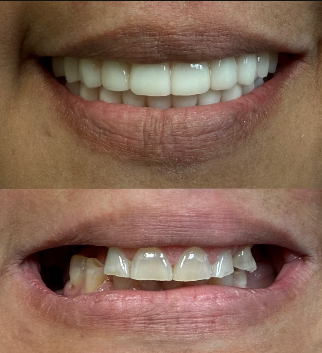 Sedation Dentistry before and after result 1 at Highline Dental Oviedo FL