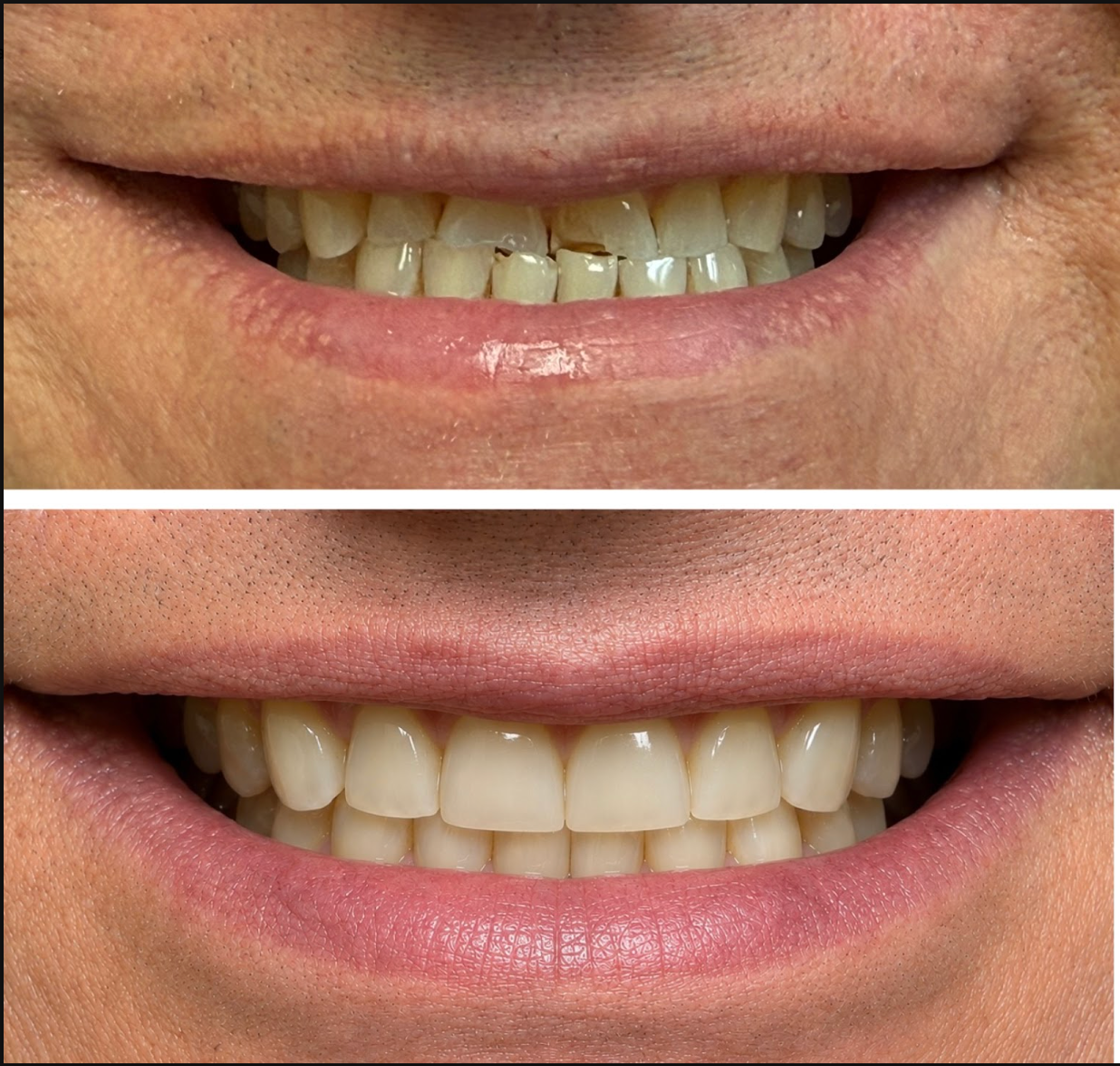 Highline Dental before and after smile transformation 5 in Oviedo FL