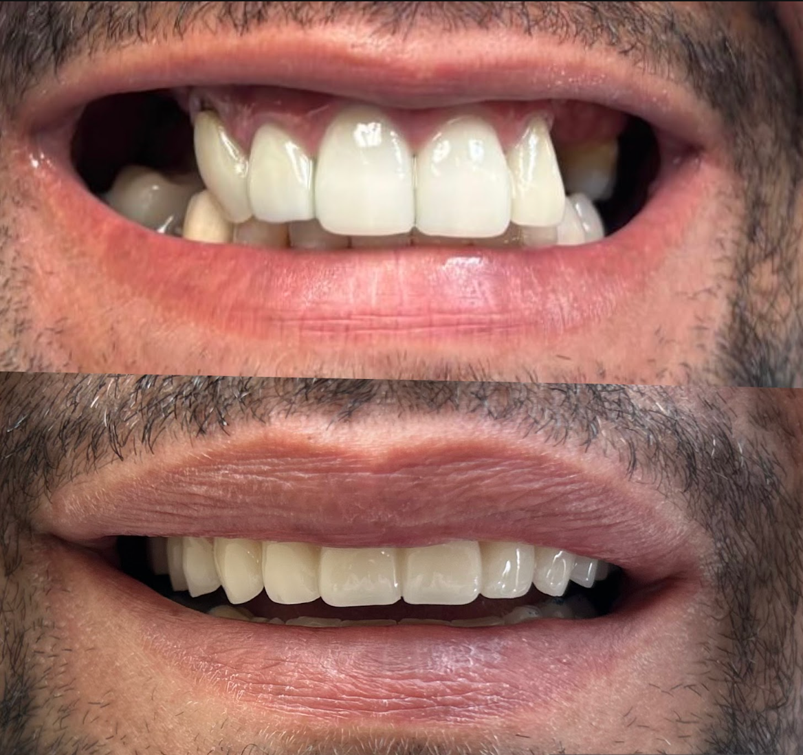 Highline Dental before and after smile transformation 6 in Oviedo FL