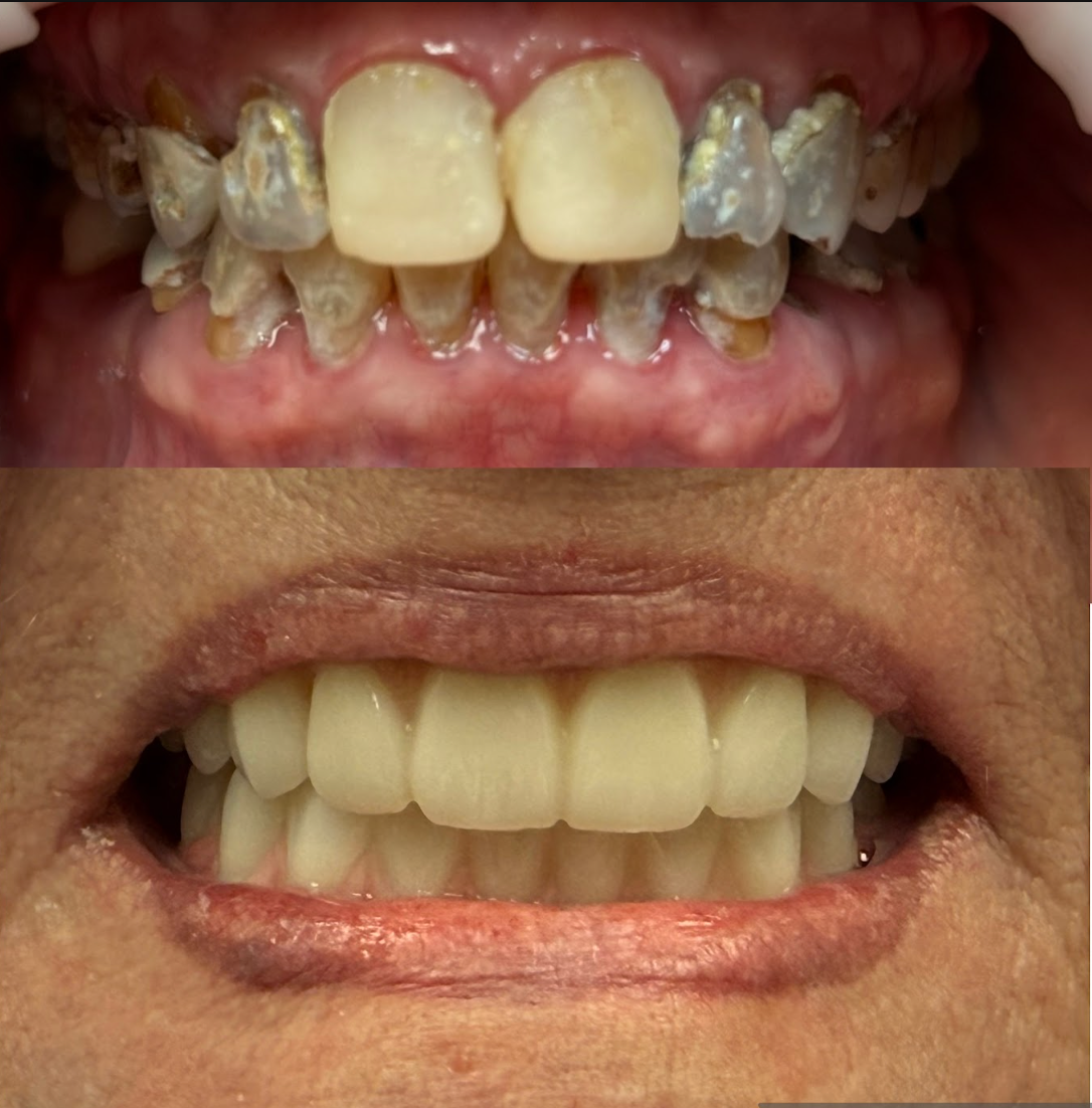 Highline Dental before and after smile transformation 8 in Oviedo FL