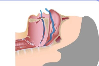Diagrama médico mostrando apneia obstrutiva do sono