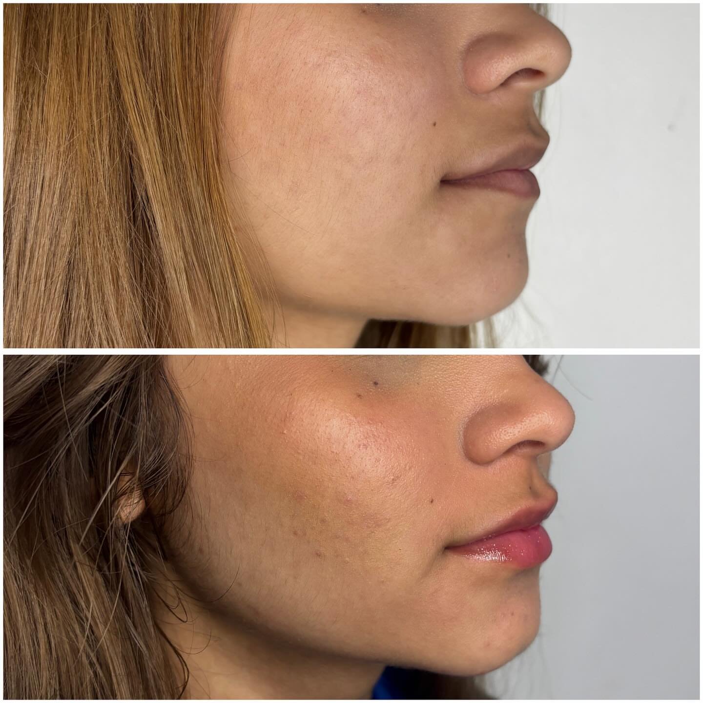 Harmonização Facial