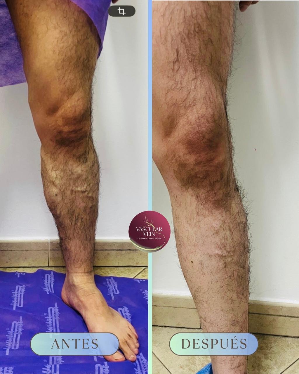 Comparación fotográfica antes y después de un caso de consulta vascular en las piernas