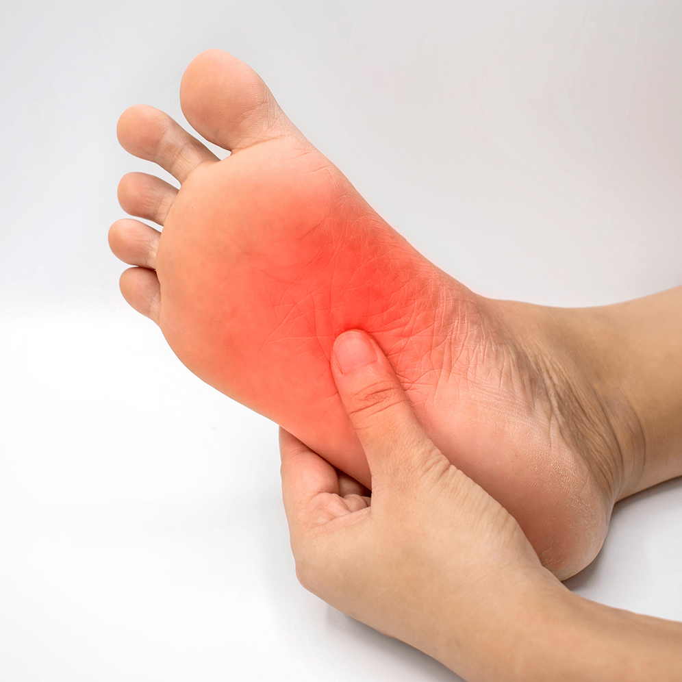 Close-up of foot with red inflamed area indicating plantar fasciitis