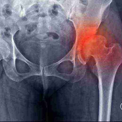 Hip X-ray showing pelvis and hip joint with inflammation
