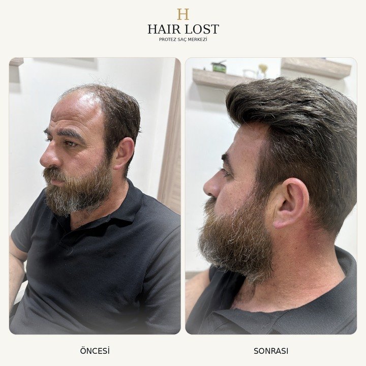 Protez saç öncesi ve sonrası vaka 10, tepe bölgesi kapatma karşılaştırması — Hair Lost Antalya