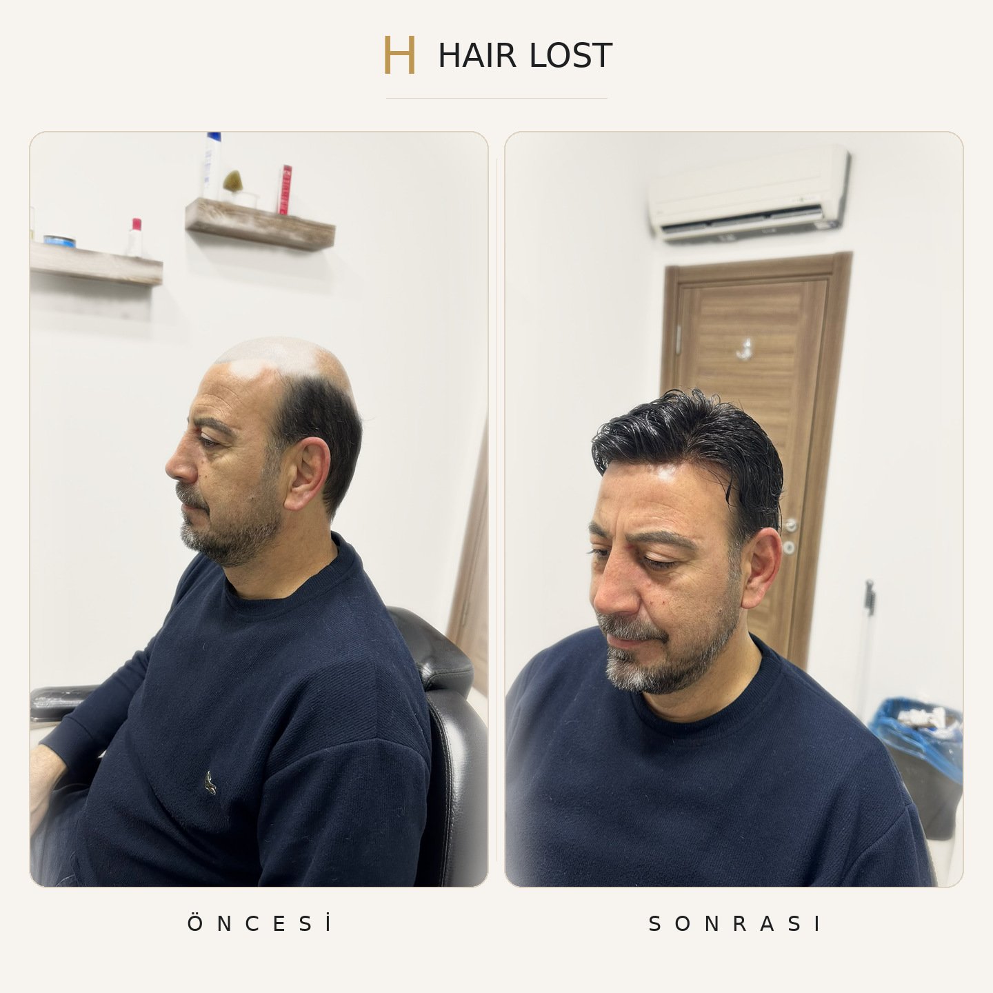 Protez saç öncesi ve sonrası lacivert sweatshirt, koyu model stüdyo — Hair Lost Antalya