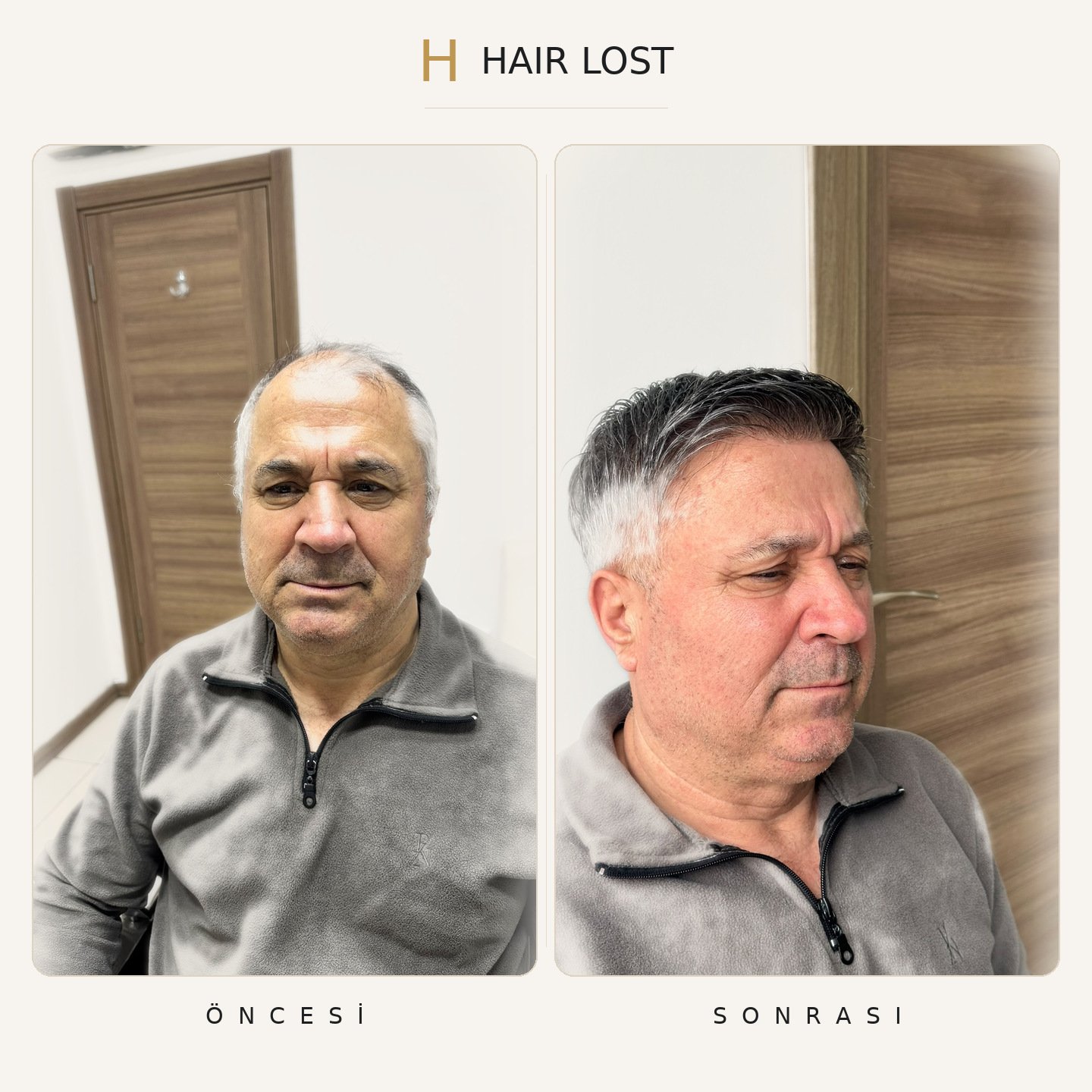 Protez saç öncesi ve sonrası gri polar ön-yan, gümüş-gri ton — Hair Lost Antalya