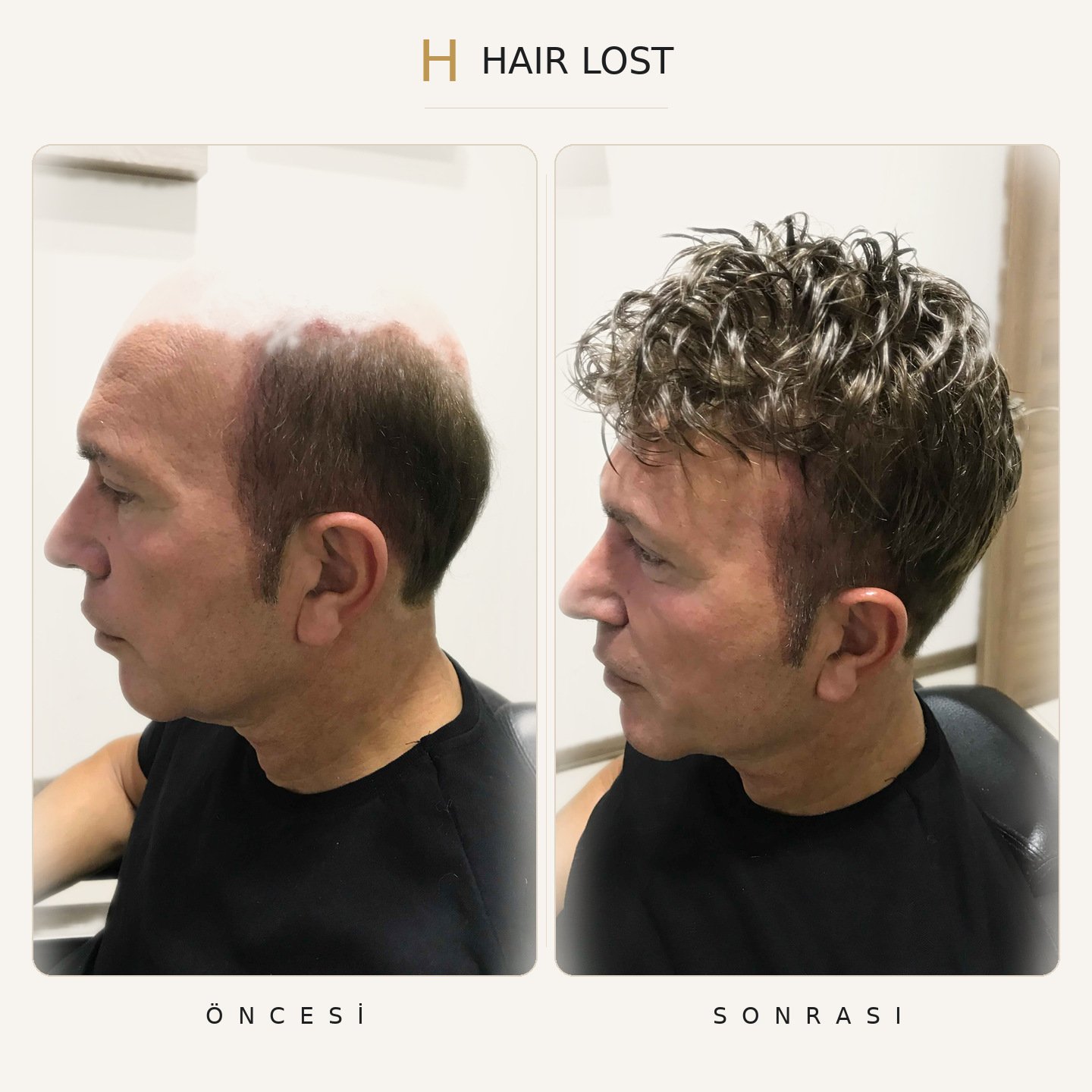 Protez saç öncesi ve sonrası yakın yan profil, saç çizgisi ve hacim — Hair Lost Antalya