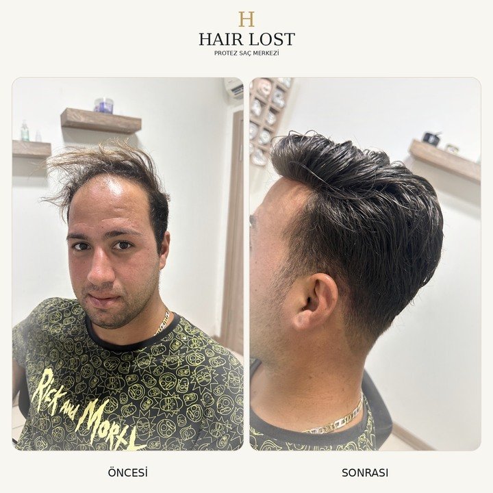 Protez saç öncesi ve sonrası doğal görünüm, ön bölge ve yan profil karşılaştırması — Hair Lost Antalya