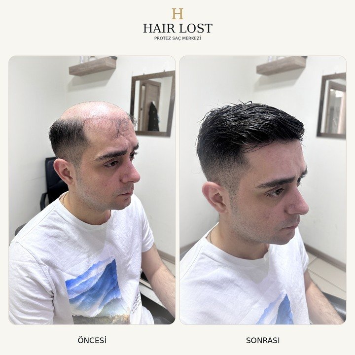 Protez saç öncesi ve sonrası yan geçiş, saç çizgisi ve yan geçiş karşılaştırması — Hair Lost Antalya