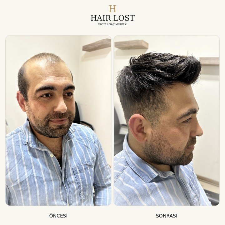 Protez saç öncesi ve sonrası doğal saç çizgisi, ön cephe ve yan profil — Hair Lost Antalya