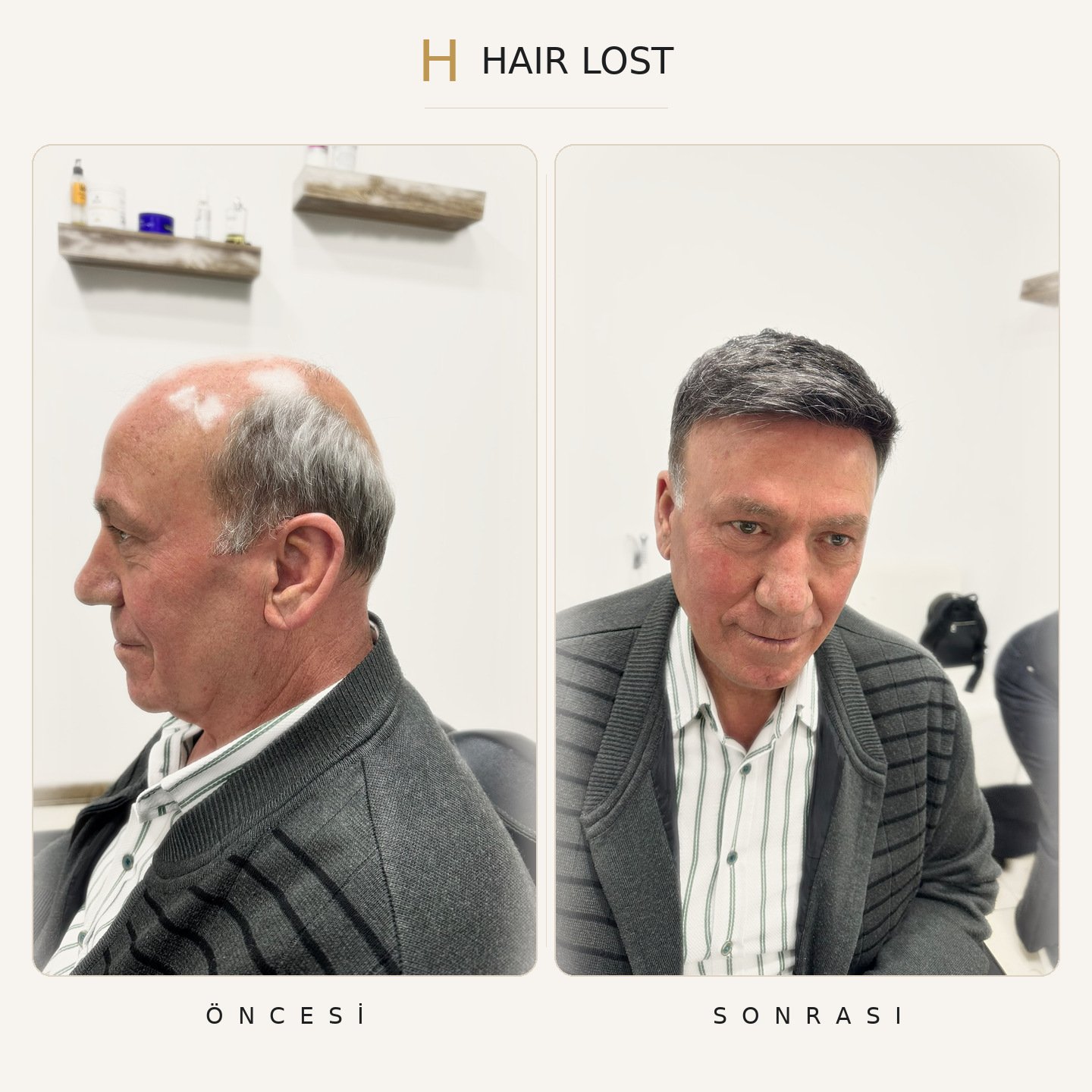 Protez saç öncesi ve sonrası çizgili gömlek yan profil, tepe kapatma — Hair Lost Antalya