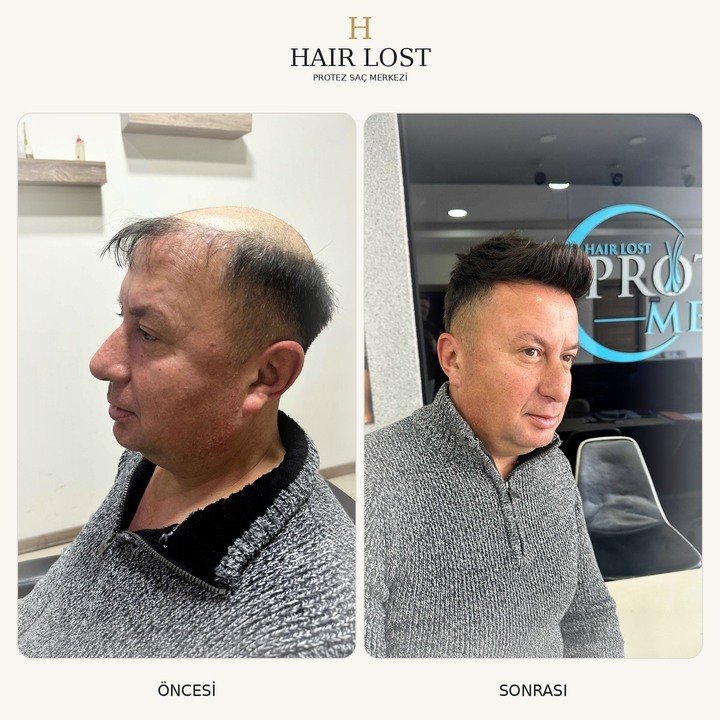 Protez saç öncesi ve sonrası vaka 13, üç çeyrek açı hacim karşılaştırması — Hair Lost Antalya