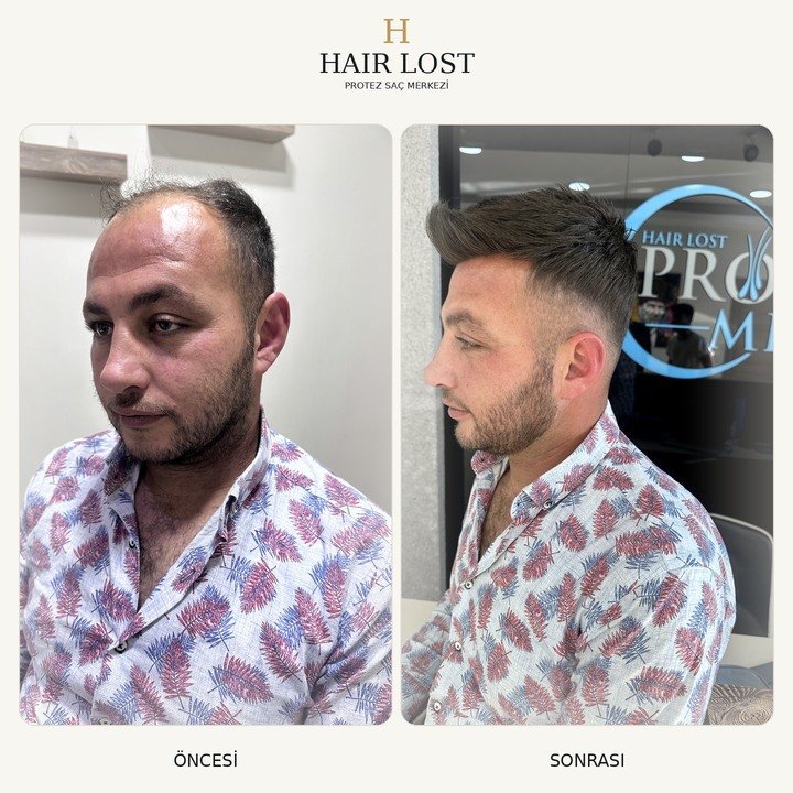 Protez saç öncesi ve sonrası stil dönüşümü, ön ve yan profil karşılaştırması — Hair Lost Antalya