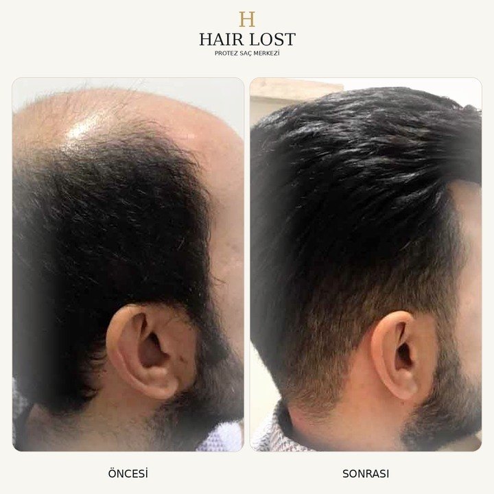 Protez saç öncesi ve sonrası vaka 16, yan profil hacim dengesi — Hair Lost Antalya