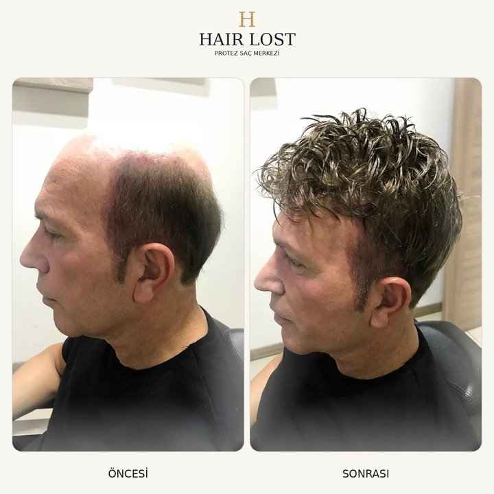 Protez saç öncesi ve sonrası vaka 11, ön cephe doğal yoğunluk karşılaştırması — Hair Lost Antalya