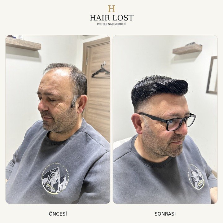 Protez saç öncesi ve sonrası modern stil, tepe kapatma ve şekillendirme — Hair Lost Antalya
