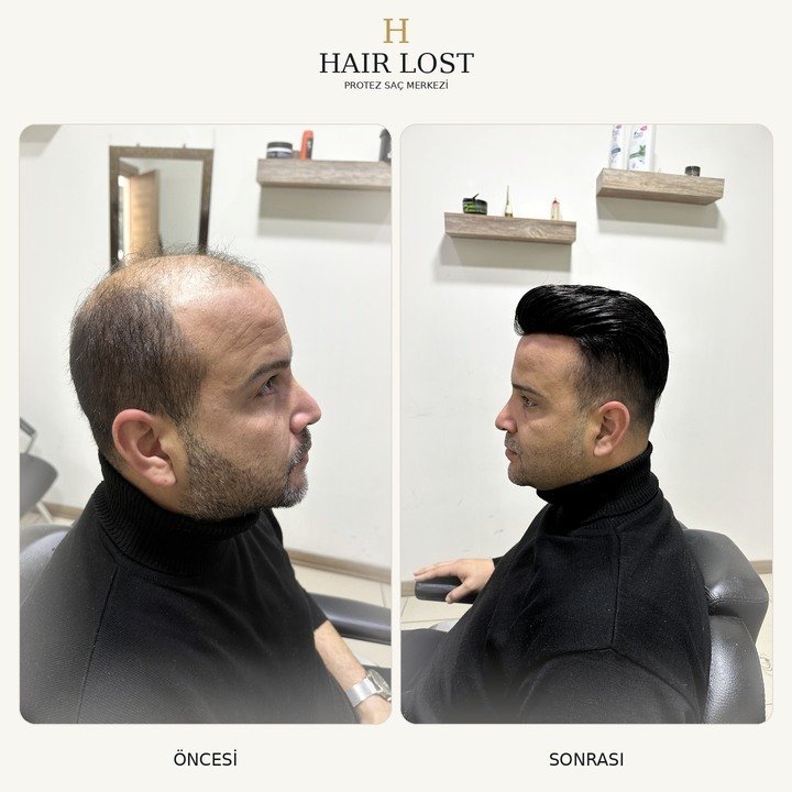 Protez saç öncesi ve sonrası koyu model, yan profil ve hacim uyumu — Hair Lost Antalya