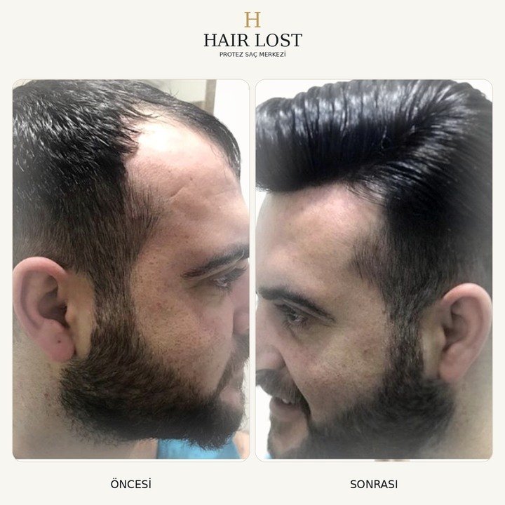 Protez saç öncesi ve sonrası vaka 19, yan profil doğal geçiş — Hair Lost Antalya