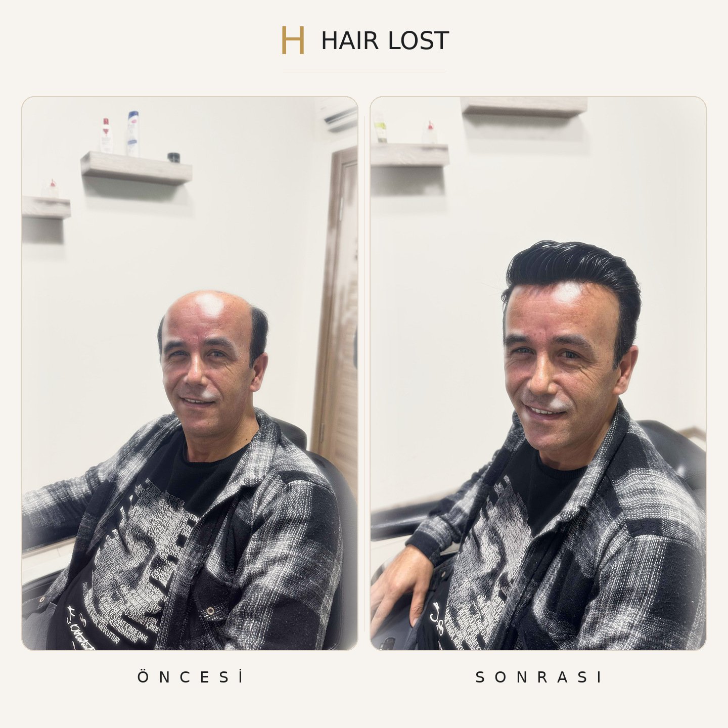 Protez saç öncesi ve sonrası gülümseyen portre, slick back stil — Hair Lost Antalya