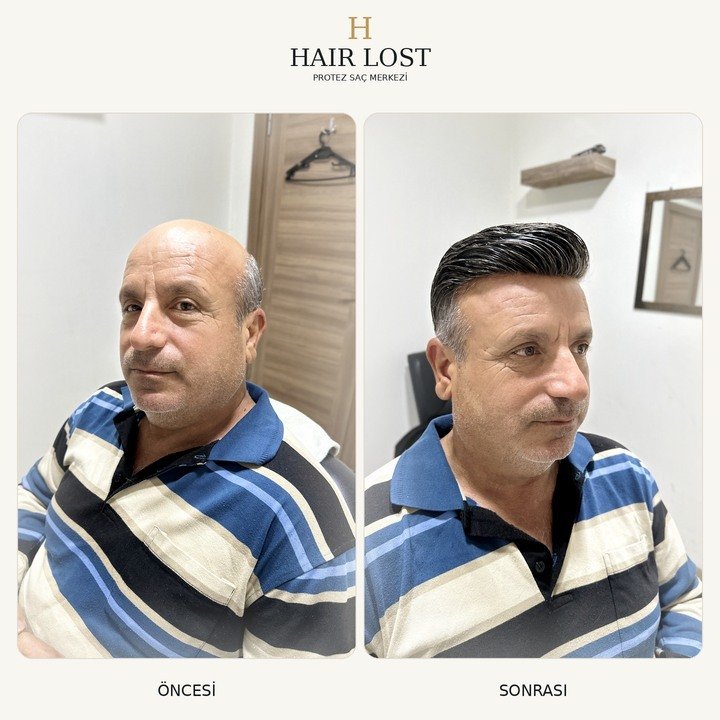 Protez saç öncesi ve sonrası klasik model, ön ve yan açı karşılaştırması — Hair Lost Antalya