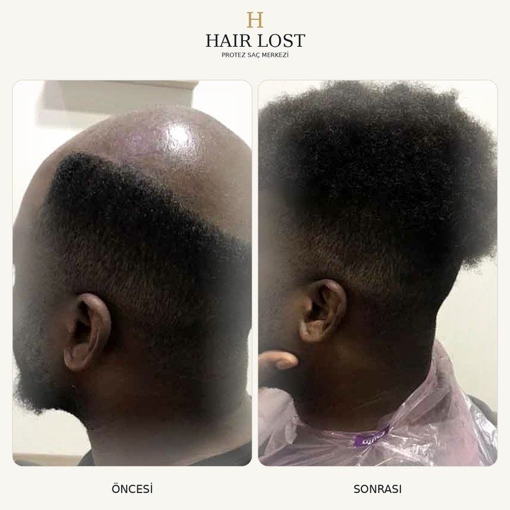 Protez saç öncesi ve sonrası vaka 14, tepe ve ön bölge kapatma karşılaştırması — Hair Lost Antalya