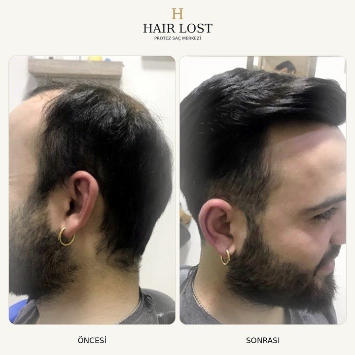 Protez saç öncesi ve sonrası vaka 20, ön ve tepe bölgesi kapatma — Hair Lost Antalya
