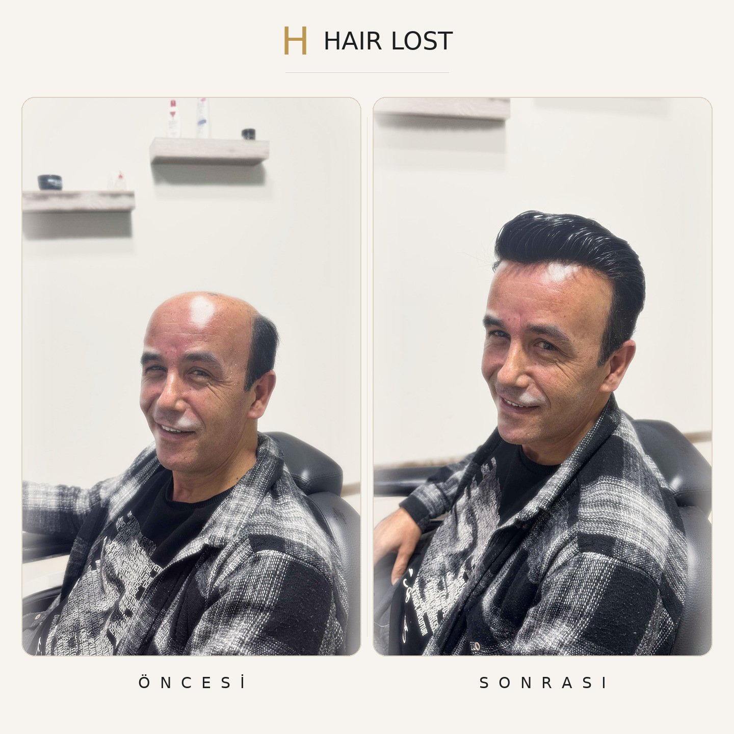 Protez saç öncesi ve sonrası yan gülümseme, renk ve parlaklık uyumu — Hair Lost Antalya