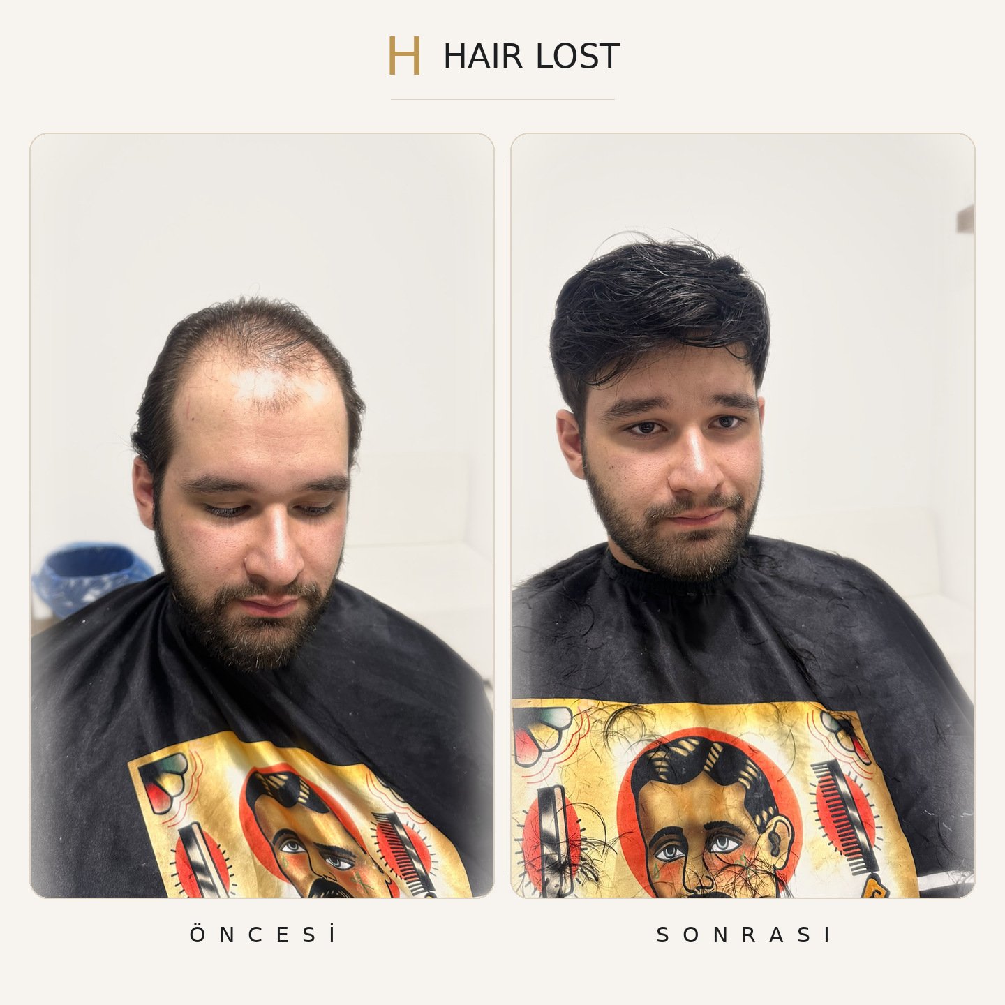 Protez saç öncesi ve sonrası genç danışan pelerin, uygulama anı stüdyo — Hair Lost Antalya