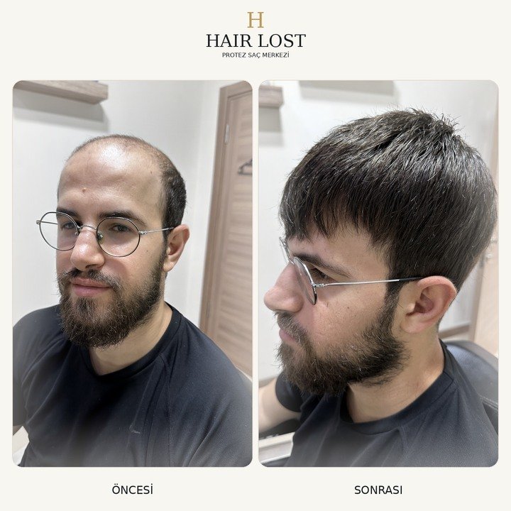 Protez saç öncesi ve sonrası gözlüklü danışan, ön ve yan açı karşılaştırması — Hair Lost Antalya
