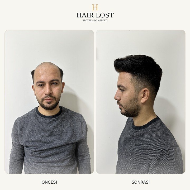 Protez saç öncesi ve sonrası kısa stil, ön cephe ve yan görünüm — Hair Lost Antalya