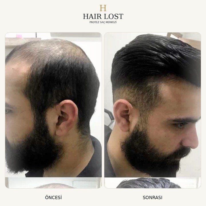 Protez saç öncesi ve sonrası vaka 15, doğal saç çizgisi ve renk uyumu — Hair Lost Antalya