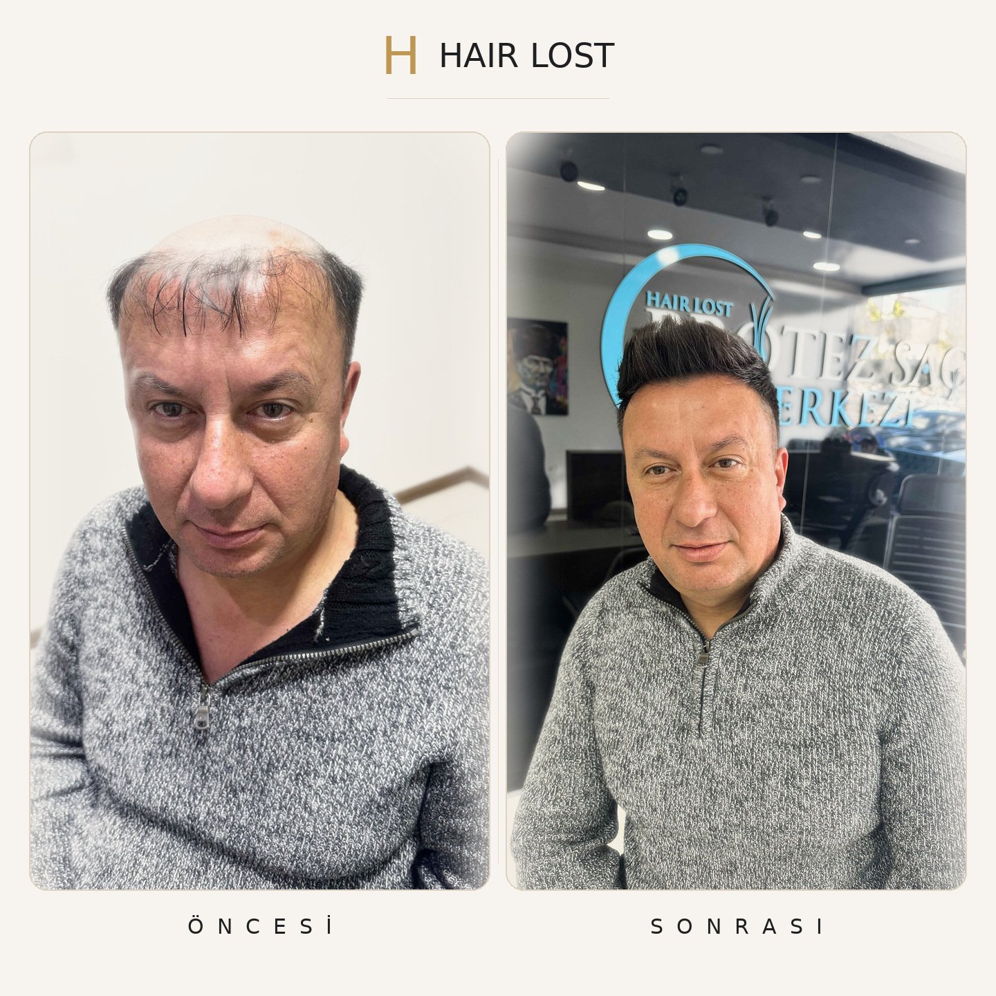 Protez saç öncesi ve sonrası gri kazak portre, ön cephe klinik — Hair Lost Antalya