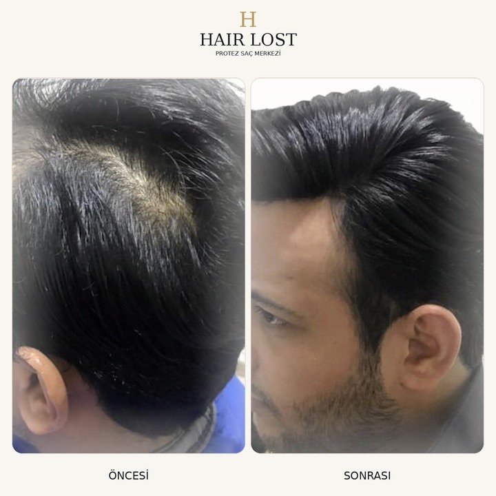 Protez saç öncesi ve sonrası vaka 21, üç çeyrek açı saç çizgisi — Hair Lost Antalya