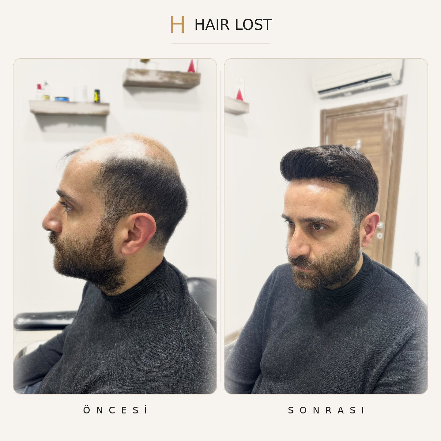Protez saç öncesi ve sonrası sakallı danışan üç çeyrek, doğal çizgi — Hair Lost Antalya