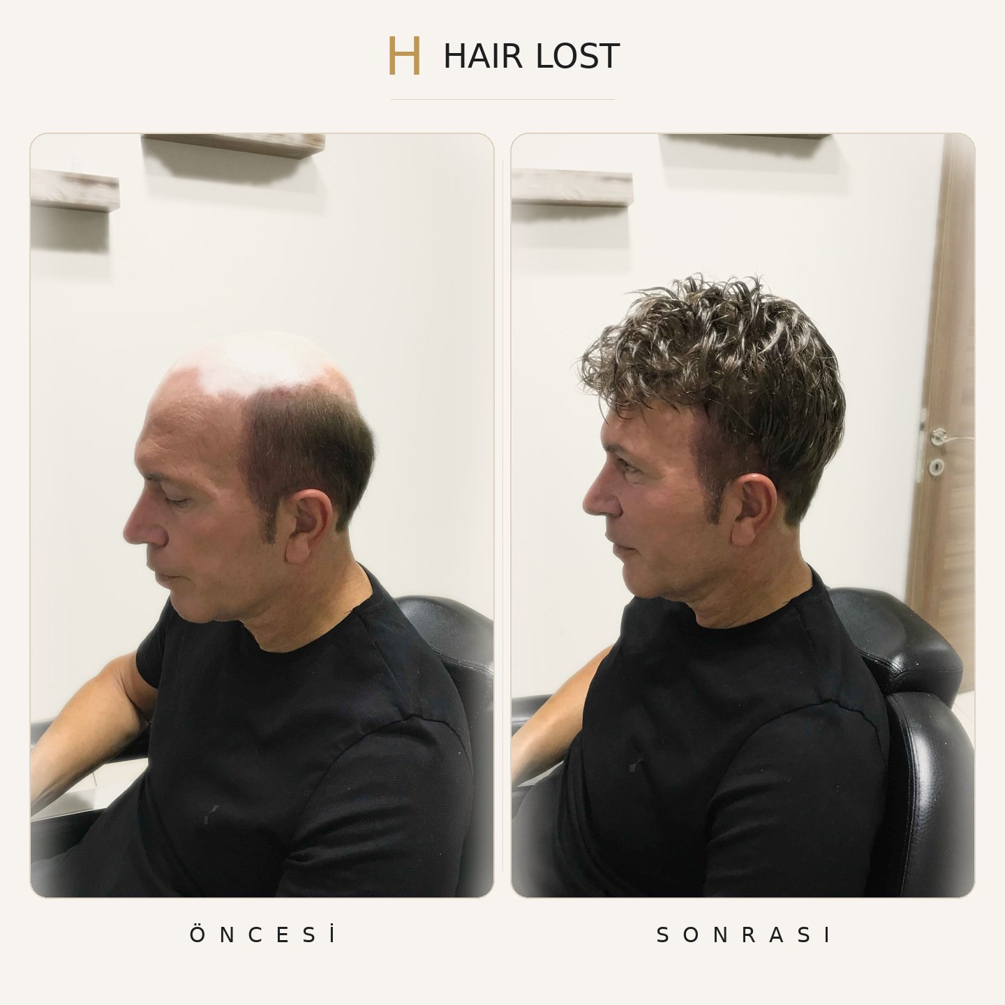 Protez saç öncesi ve sonrası oturur poz, tam tepe kapatma — Hair Lost Antalya