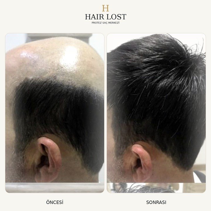 Protez saç öncesi ve sonrası vaka 22, yan profil hacim ve doğal görünüm — Hair Lost Antalya