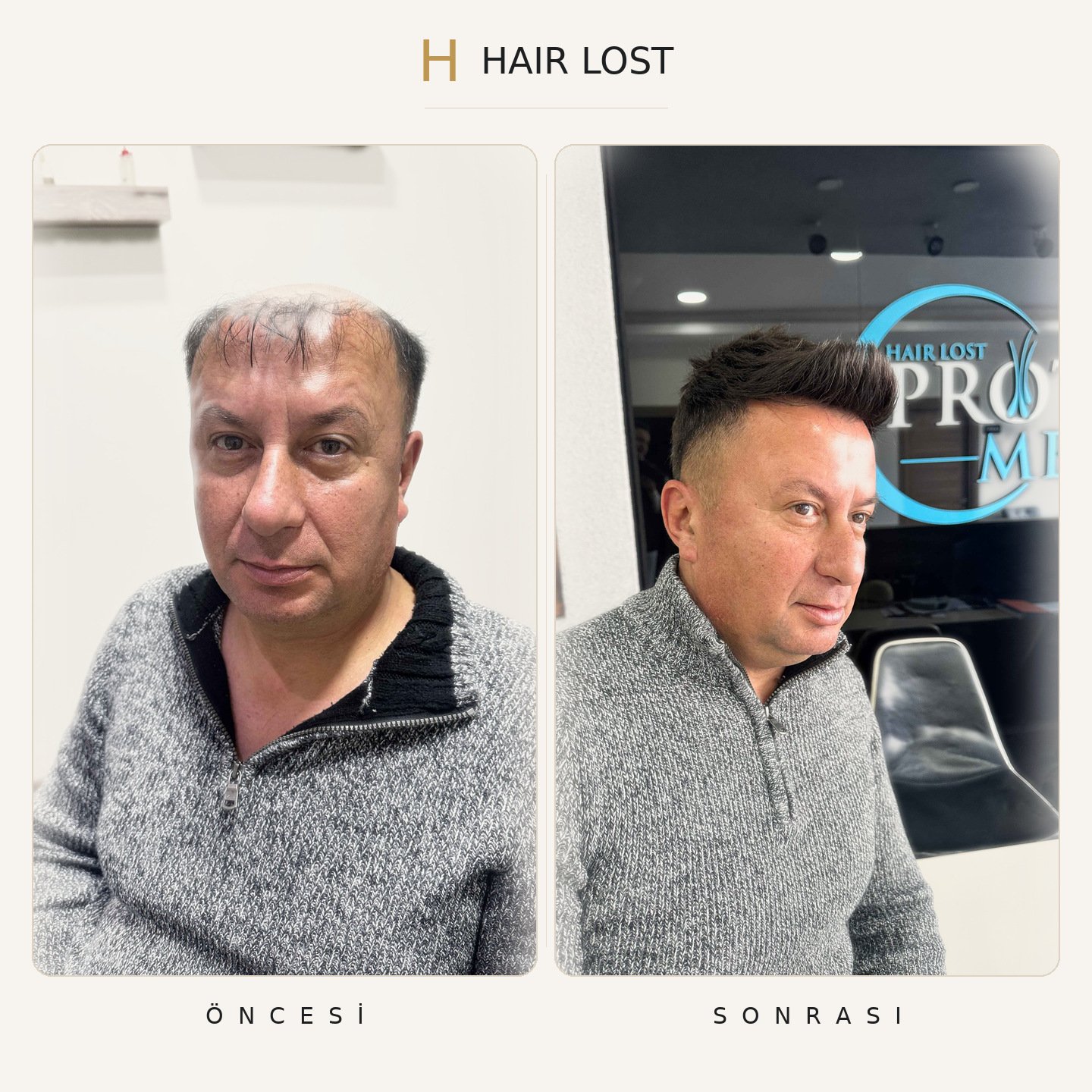 Protez saç öncesi ve sonrası fade portre, ön-yan açı stüdyo — Hair Lost Antalya