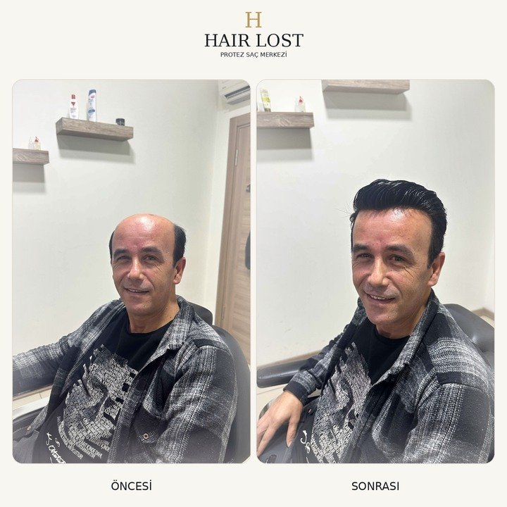 Protez saç öncesi ve sonrası vaka 12, yan profil saç çizgisi karşılaştırması — Hair Lost Antalya