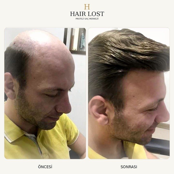 Protez saç öncesi ve sonrası vaka 17, ön cephe yoğunluk karşılaştırması — Hair Lost Antalya