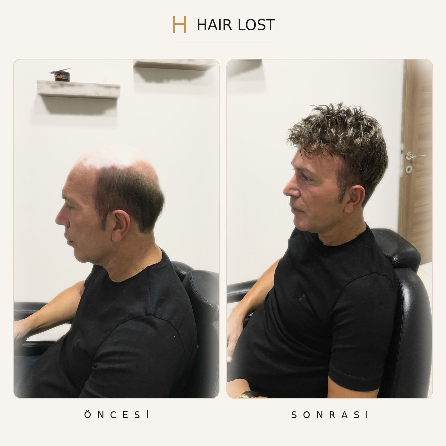 Protez saç öncesi ve sonrası yan profil, tepe açıklığı kıvırcık model — Hair Lost Antalya